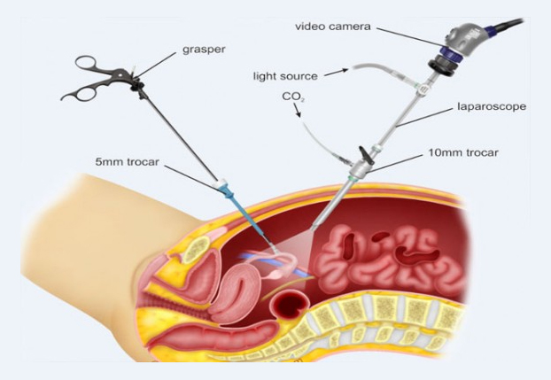 Laparoskopi / Histeroskopi