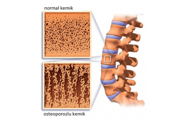 Osteoporoz (Kemik Erimesi)