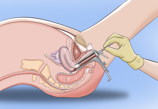 PAP-SMEAR (Sürüntü) Testi